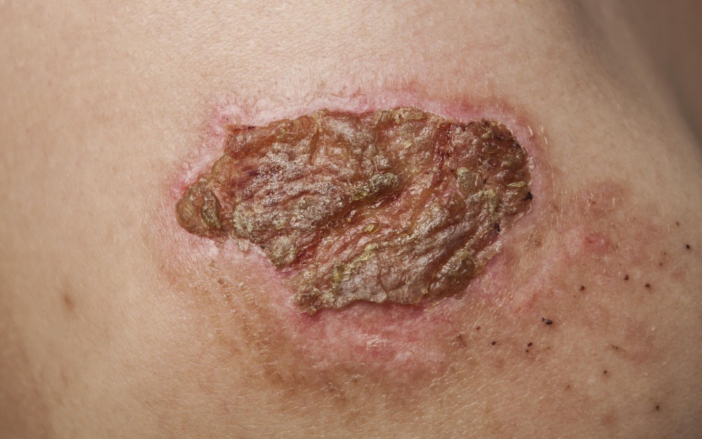 Curvy surface wound