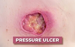 Pressure ulcer