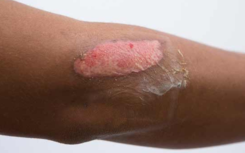 Secondary burn care