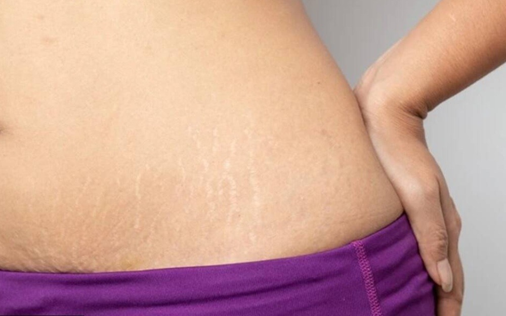 Stretch marks