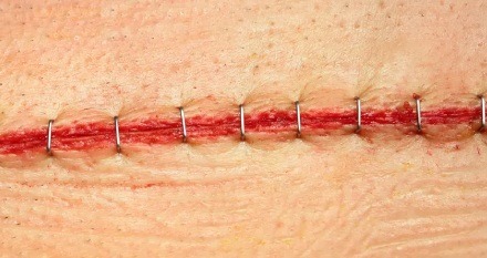 Surgical Wound Healing