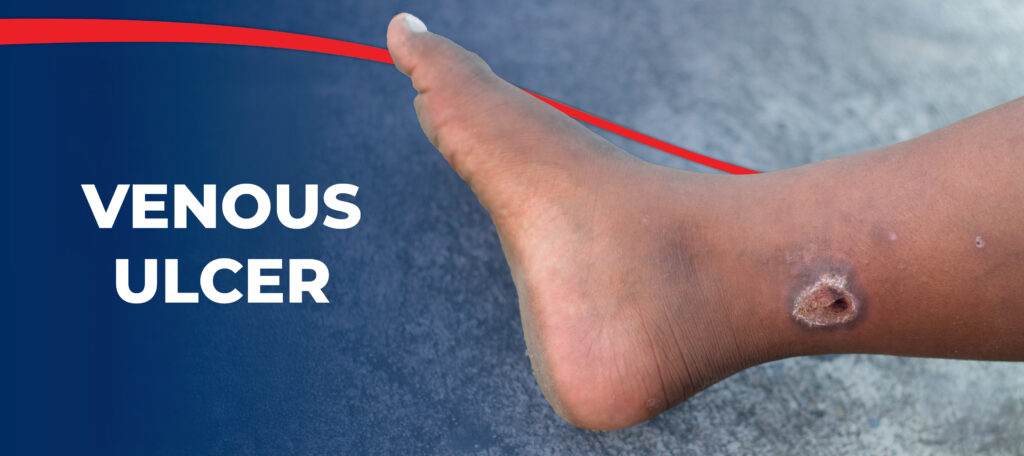 Venous ulcer