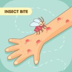 Insect Bites