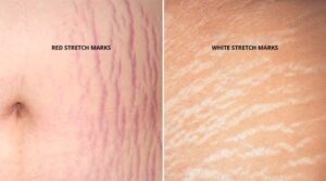 Stretch Marks