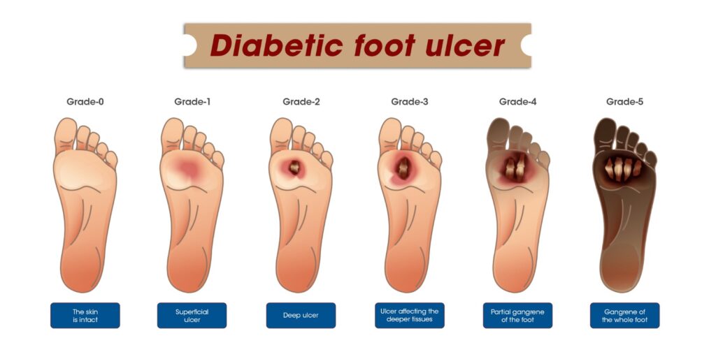 Diabetic foot ulcer