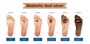 Diabetic foot ulcer