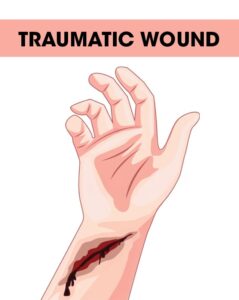 Traumatic Wound