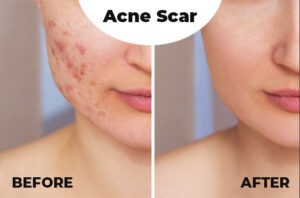 Acne scar