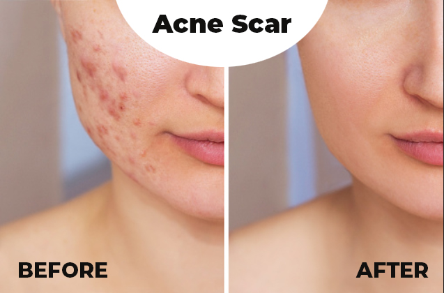Acne Scars: Types And Causes
