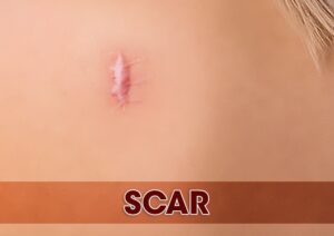 Scars