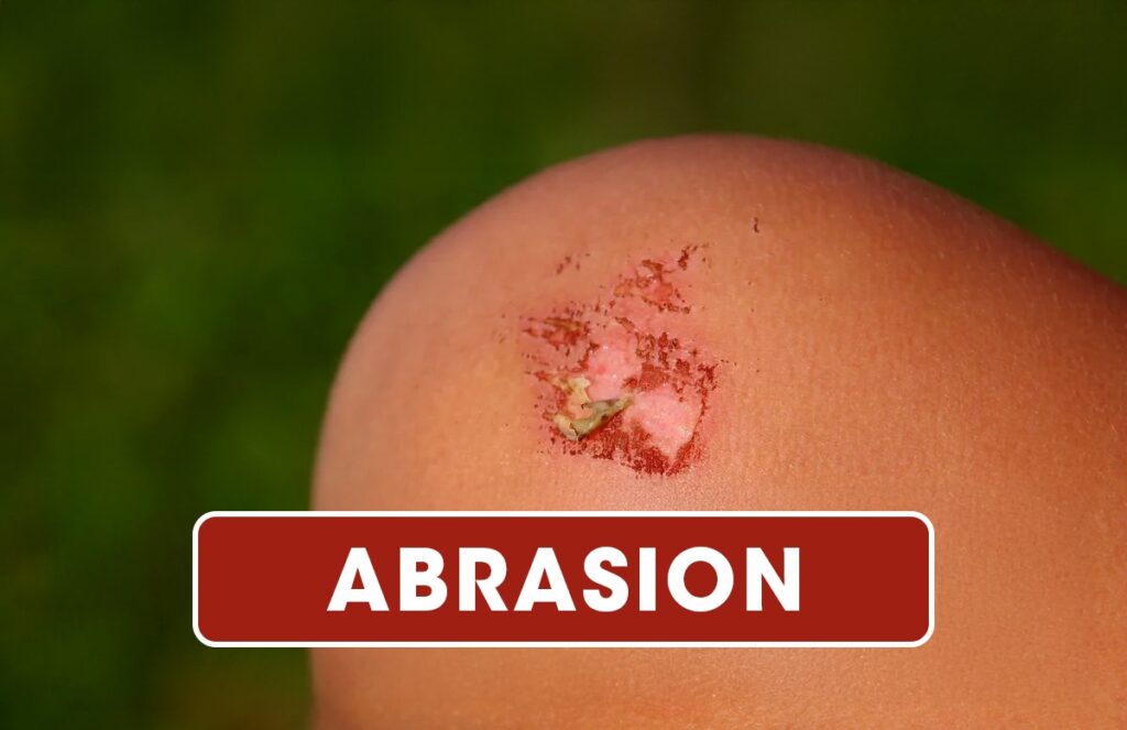 Comprehensive Guide To Abrasions