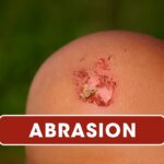 Comprehensive Guide To Abrasions