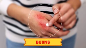 Ointment for burnt hand