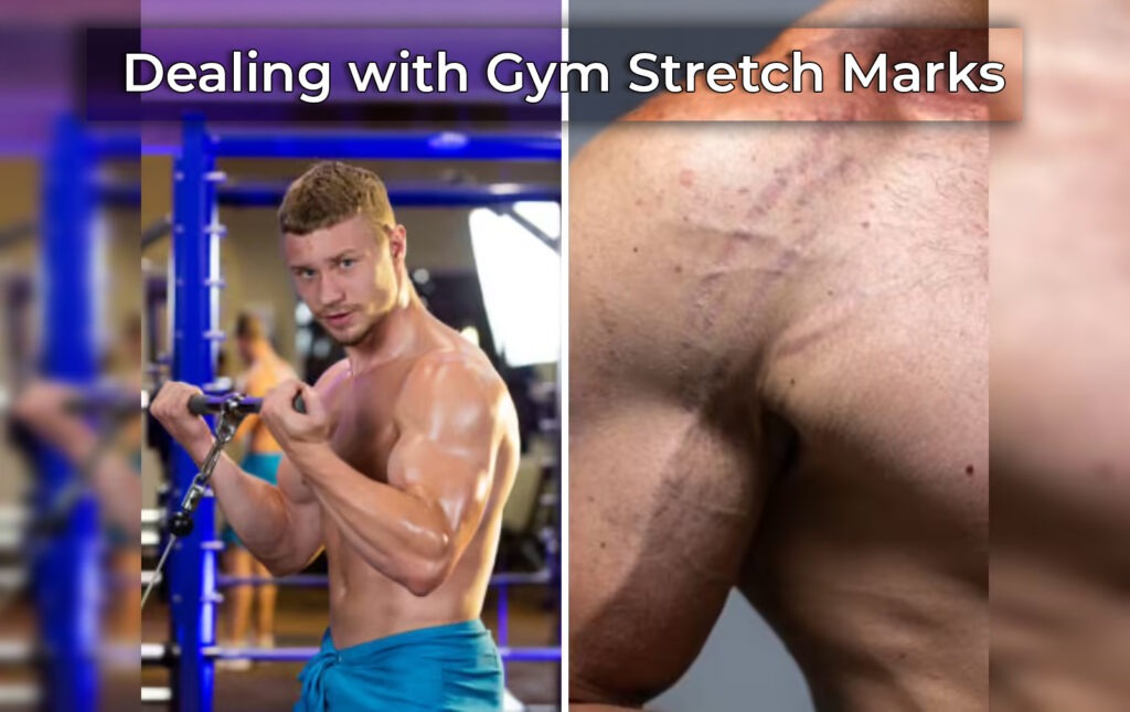 Dealing With Gym Stretch Marks? Here’s all you need to know!