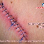 Surgical Wound Infection: Causes, Symptoms, Treatment