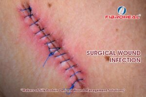 Surgical Wound Infection