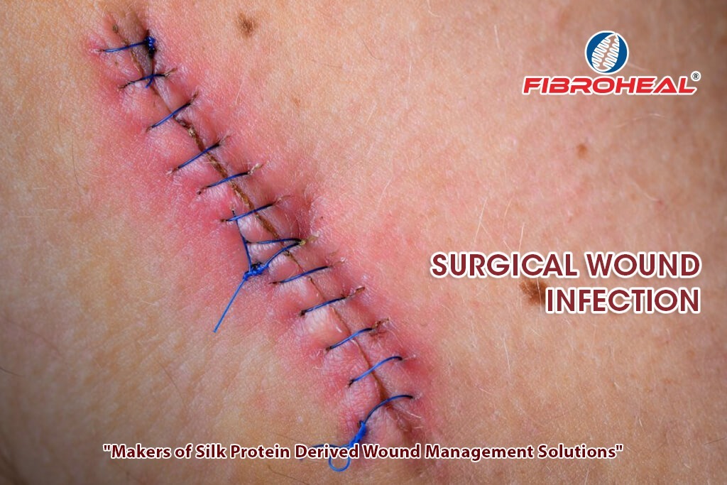 Surgical Wound Infection: Causes, Symptoms, Treatment