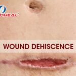 Wound Dehiscence