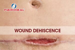 Wound Dehiscence