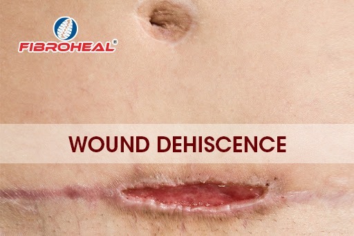 Wound Dehiscence