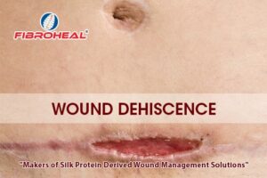 Wound Dehiscence